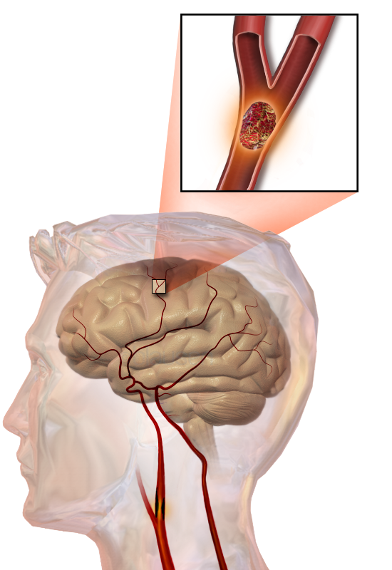 Ilustração de um acidente vascular cerebral embólico, mostrando um bloqueio alojado em um vaso sanguíneo. - Blausen Medical Communications, Inc.