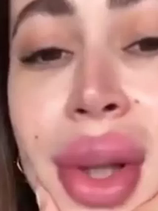 Carol Narizinho choca fãs ao mostrar a boca após procedimento