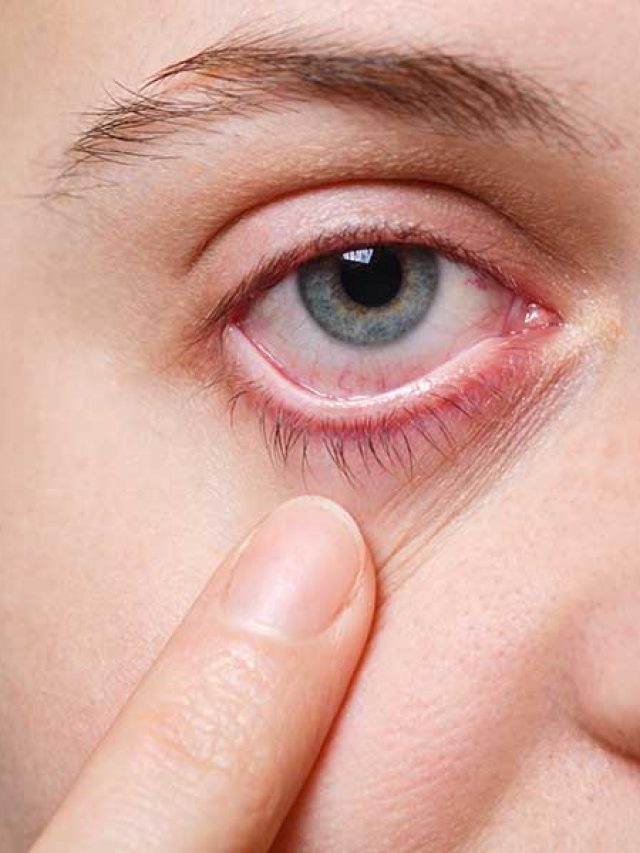 Atraso no diagnóstico do glaucoma pode resultar em perda de visão