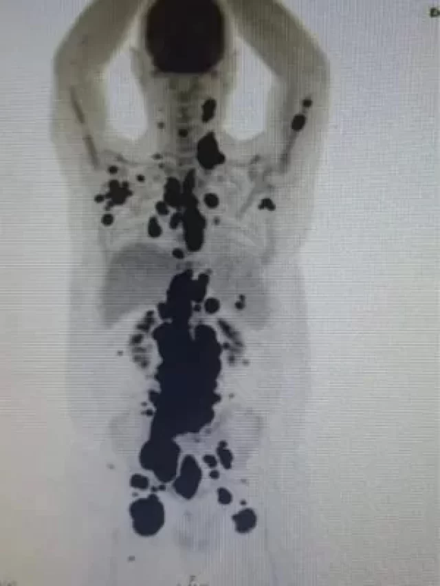 Finalmente temos cura para o câncer? Conheça novo tratamento inovador