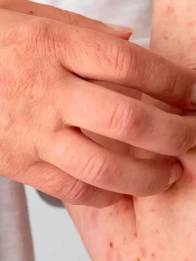 SP confirma morte por febre maculosa