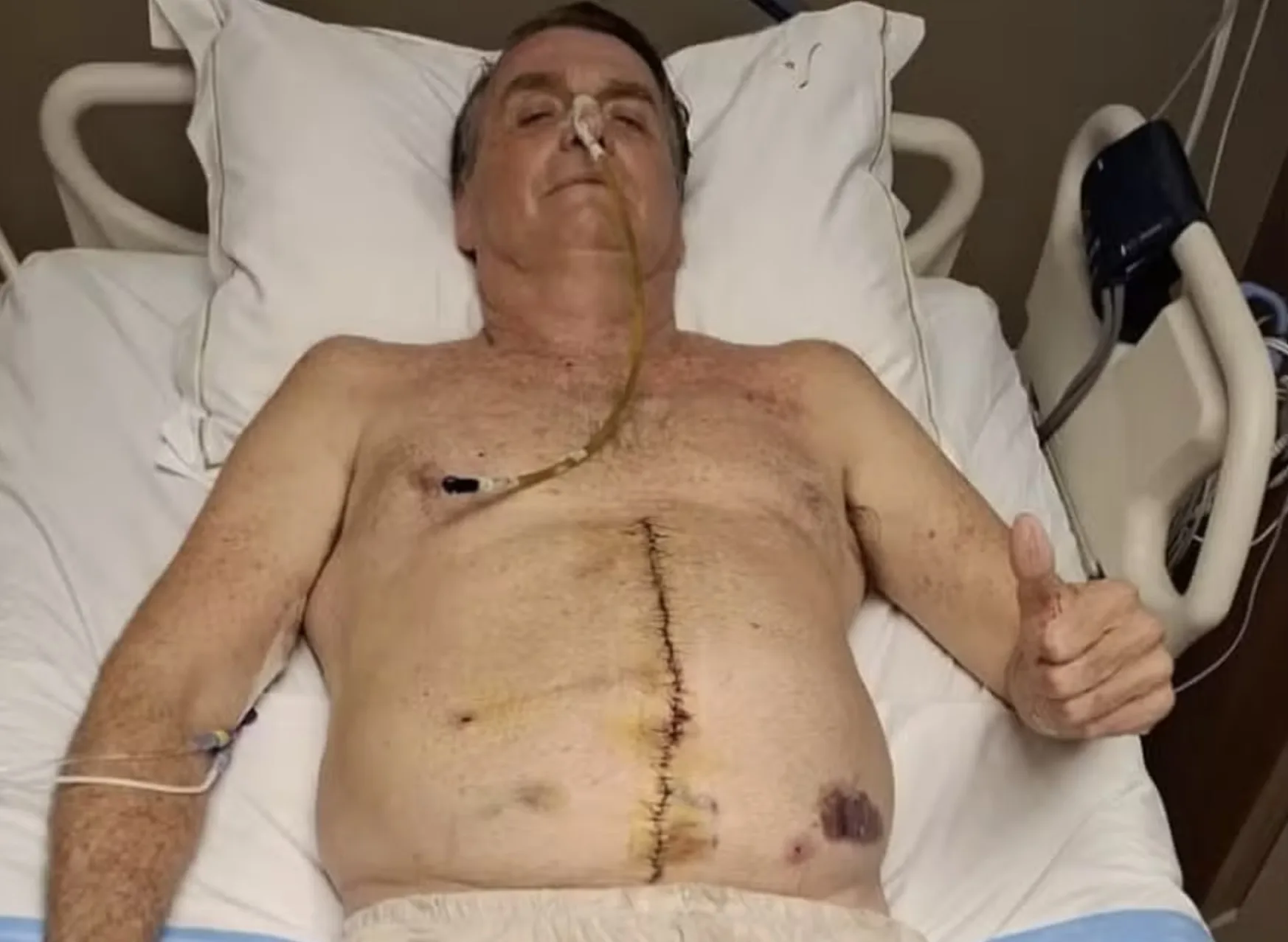 Bolsonaro segue internado na UTI do Hospital DF Star com piora nos exames hepáticos e pressão elevada, após cirurgia para tratar obstrução intestinal realizada no início de abril.