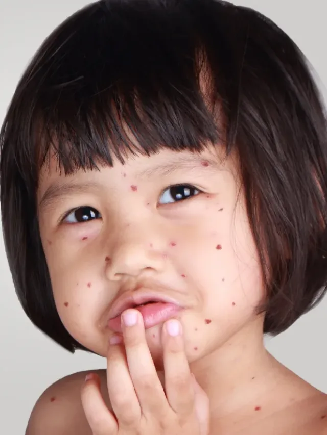 Varíola matou 300 milhões antes da erradicação oficial em 1979